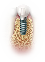 dental implant dentist anchorage